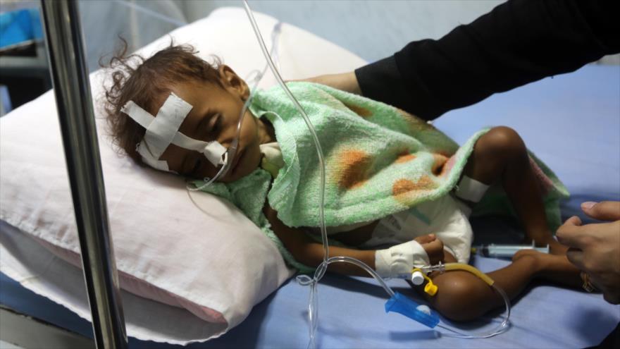 Un menor yemení, con alto grado de malnutrición, en un hospital en la ciudad portuaria de Hodeidah, 21 de noviembre de 2017.