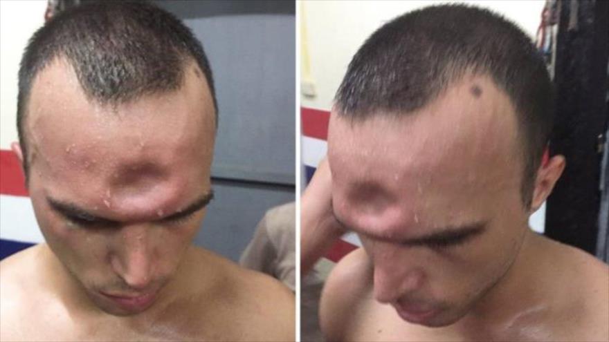 Escalofriante: Brutal fractura de luchador de Muay Thai