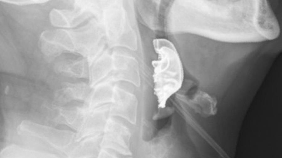 El resultado de la radiología del anciano británico que sobrevivió después de vivir más de una semana con una dentadura postiza atorada en la garganta.