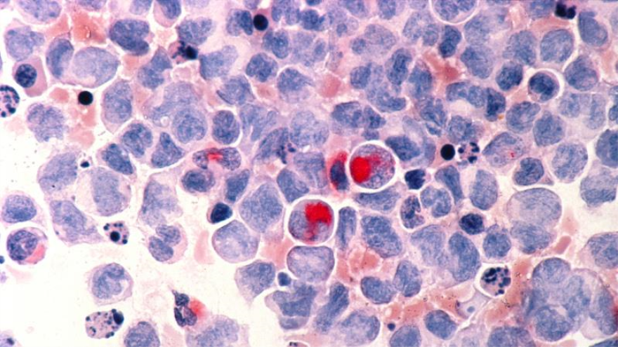 Imagen microscópica muestra células de un paciente con leucemia