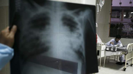 OMS: Cada día 1000 personas enferman de tuberculosis en Europa