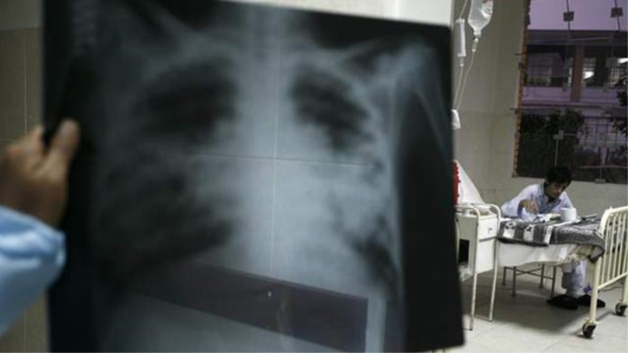 Radiografía de un paciente con tuberculosis