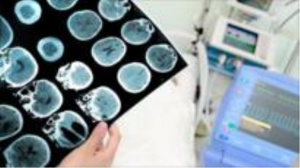 Fármaco de Biogen contra Alzheimer reduce deterioro cognitivo
