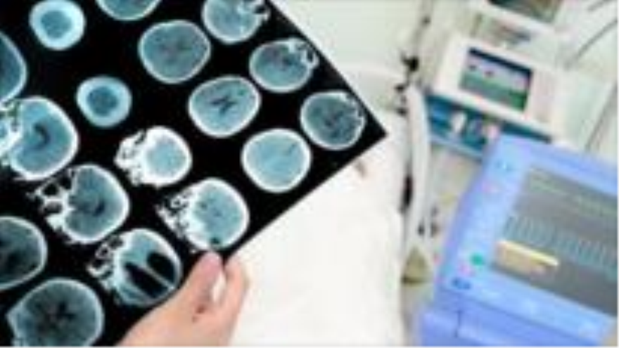 Prueba de imagen de una persona con Alzheimer