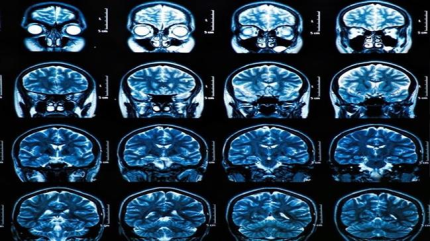Identifican mecanismo de la inflamación del cerebro 