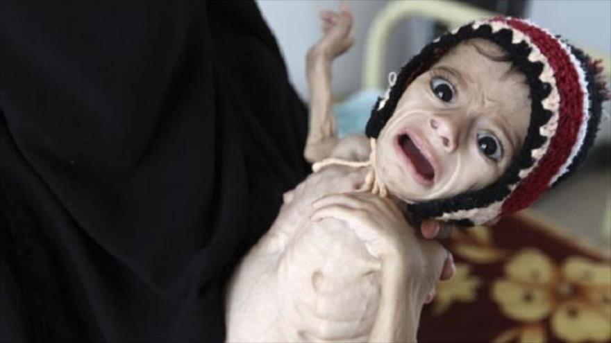 Un tercio de un millón y medio de niños yemeníes que sufren desnutrición, necesita ayuda urgente