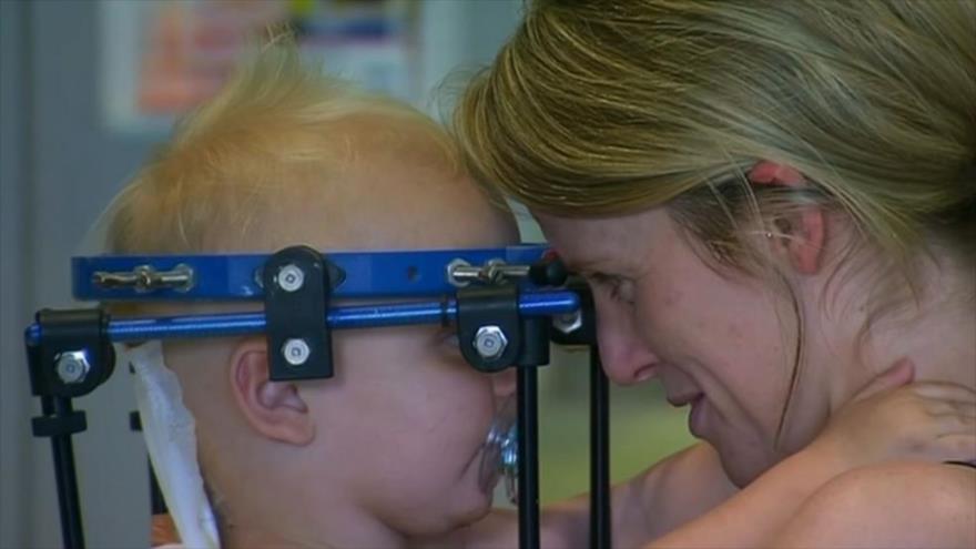Un grupo de doctores en Australia logró unir exitosamente el cráneo con la columna de un bebe de tan solo 16 meses.