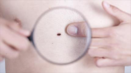 Personas con más de once lunares en el brazo derecho propensas a padecer cáncer
