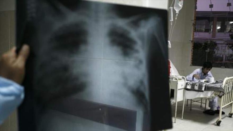 Radiografía de un paciente con tuberculosis.