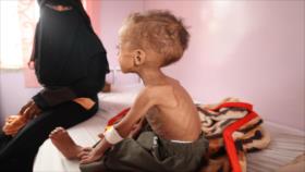 Unicef demanda acto de urgencia ante catastrófica situación de niños yemeníes