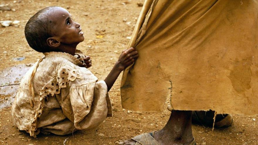 Un niño desnutrido de Somalia.
