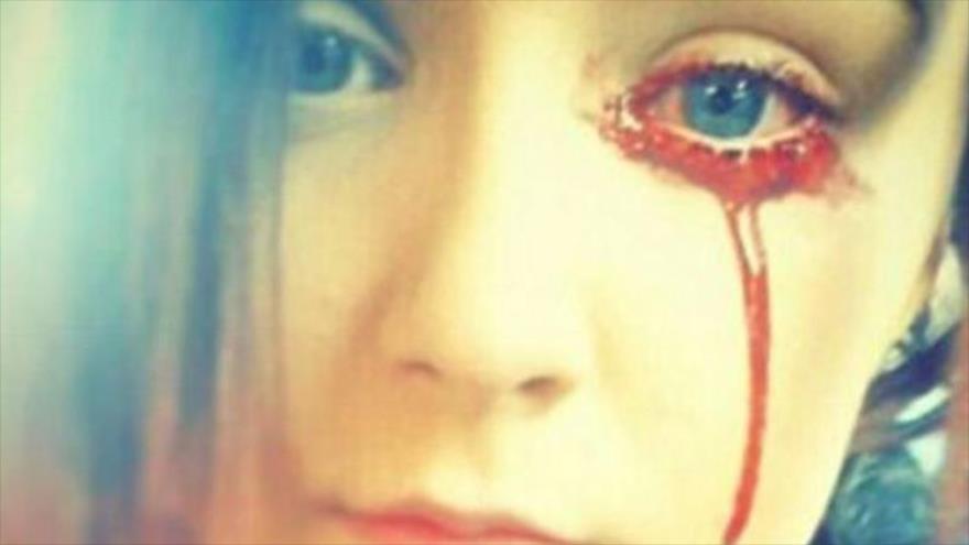Fotos: Joven británica que llora sangre es un misterio para médicos | HISPANTV