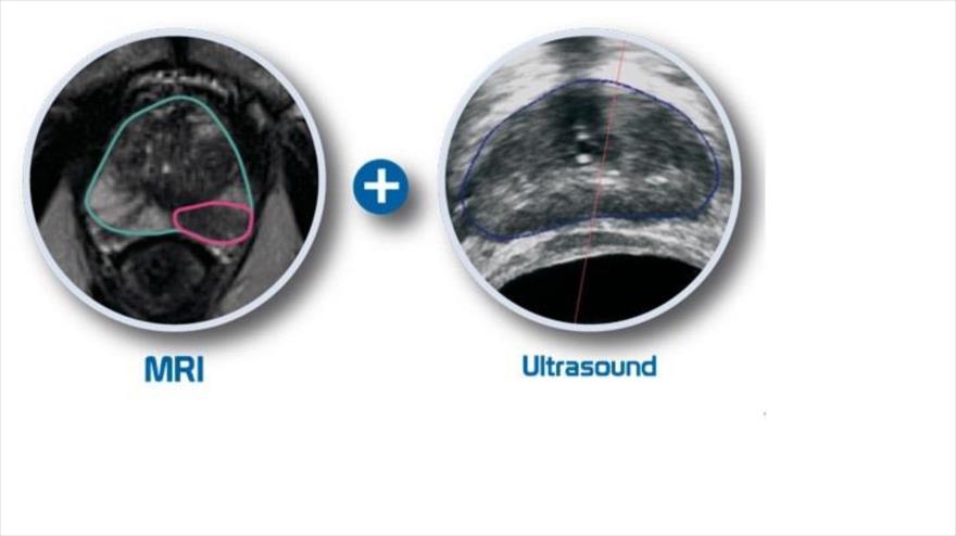 Cáncer de próstata diagnosticado con sistema de imagen por resonancia magnética (MRI) (izda.) y método ultrasónico (dcha.).
