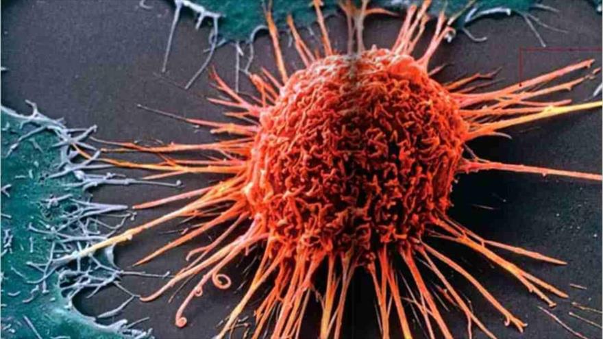 Descubren un método contra el cáncer sin uso de quimioterapia | HISPANTV