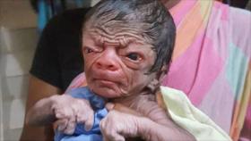 ¡Chocante!: Nace un bebé con el rostro de un viejo de 80 años