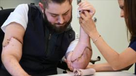 Exsoldado estadounidense recibe doble trasplante de brazos