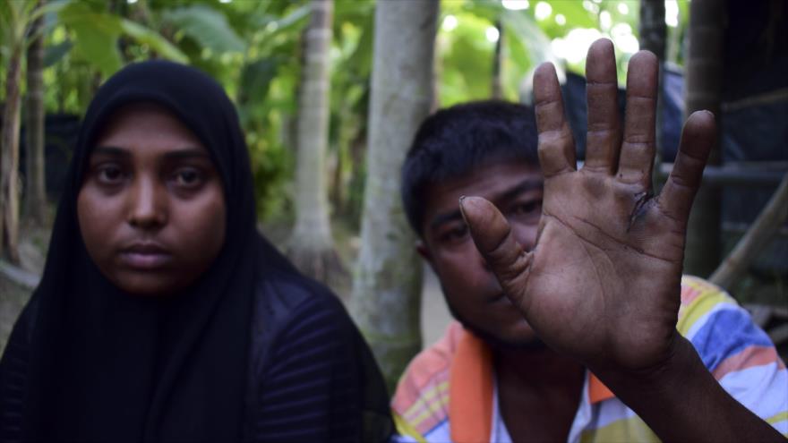 Un refugiado rohingya muestra su mano herida, 24 de noviembre de 2016.