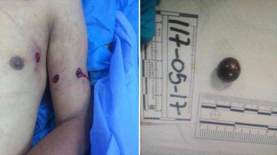 La foto tomada de la autopsia de Miguel Castillo muestra que la bala impactó en el brazo izquierdo de la víctima para luego penetrar en el tórax.