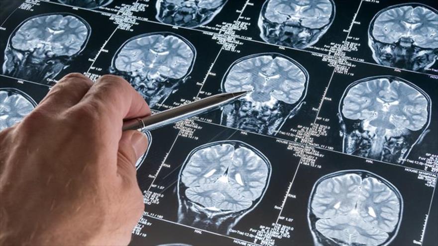 El sistema inmune alerta de un cáncer cerebral cinco años antes de que aparezcan los síntomas.