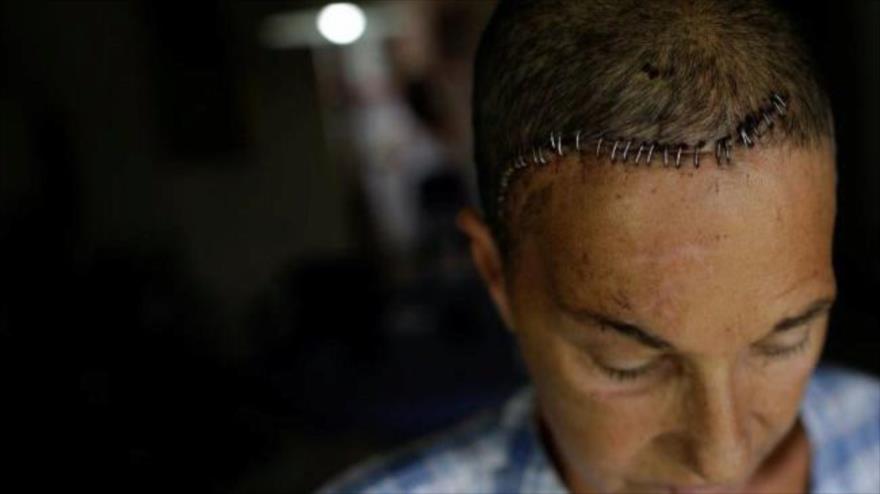 Yolyter Rodriguez, de 56, fue herida en la cabeza por el impacto de un cartucho metálico de gas lacrimógeno.