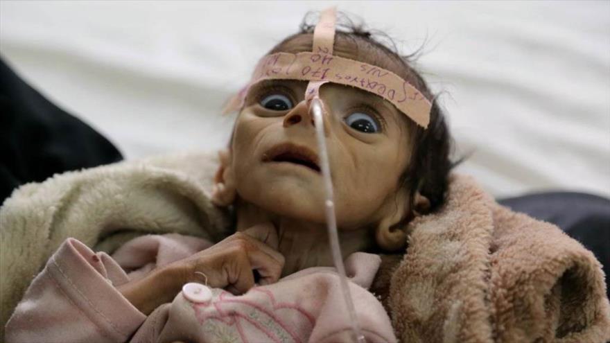 Unicef: Cada 10 minutos muere un niño en Yemen de enfermedades