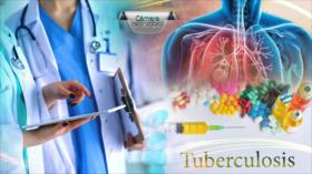 Cámara al Hombro: La tuberculosis: un drama para más de 30 000 peruanos 