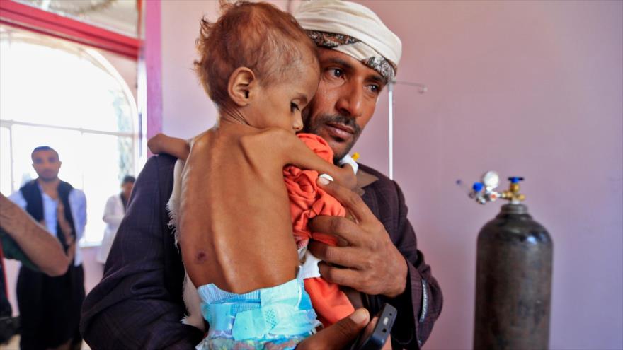 Un niño yemení que sufre de desnutrición en un hospital en Sana, 6 de octubre de 2018 (Foto: AFP).