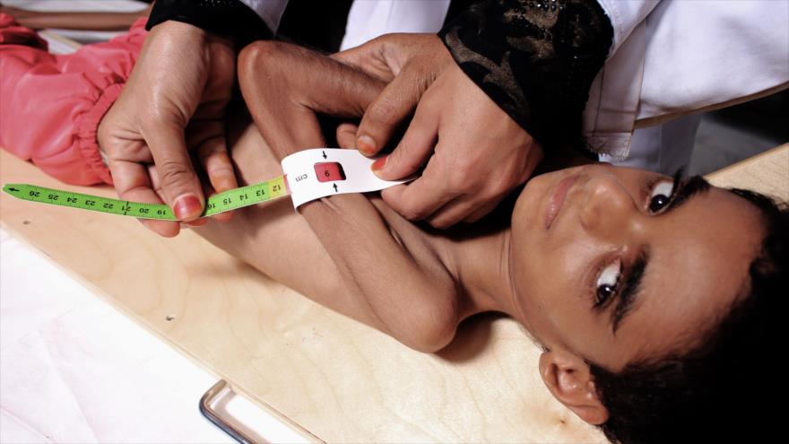 Una niña afectada por desnutrición, hospitalizada en Saná, la capital de Yemen, 6 de octubre de 2018.