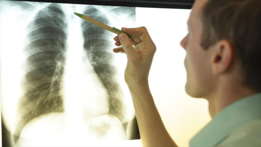 Un médico analiza una radiografía de tórax. (FOTO: Drweil.com)