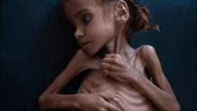 Vídeo: Murió la niña yemení Amal, símbolo de la hambruna en Yemen