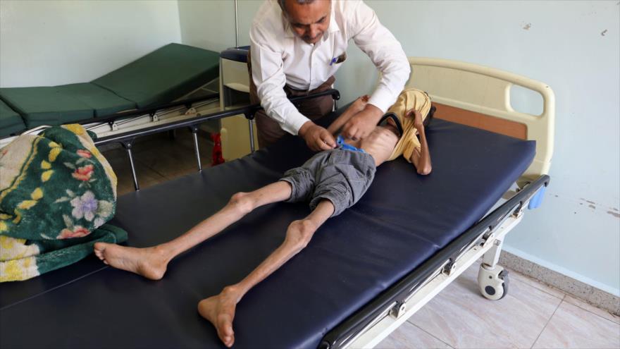 Un niño yemení de 10 años sufre desnutrición severa , 30 de octubre de 2018. (Foto:AFP)