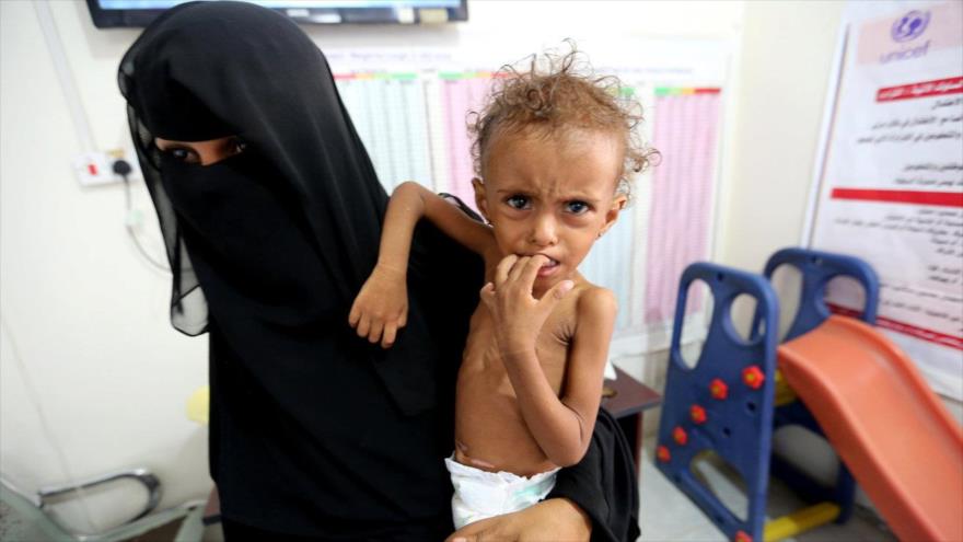 Una niña yemení desnutrida en un hospital en Al-Hudayda, en el oeste de Yemen, 3 de noviembre de 2018. (Fuente: Reuters)