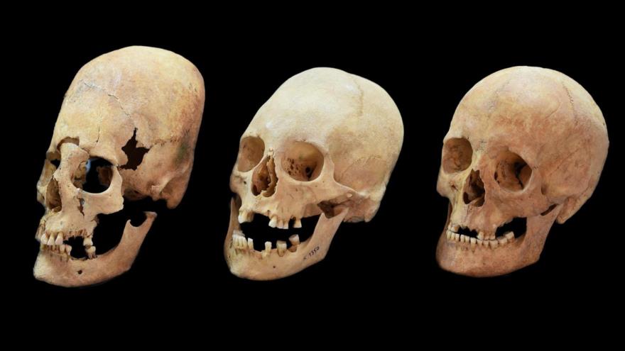 Cráneos humanos con diferentes grados de deformación.