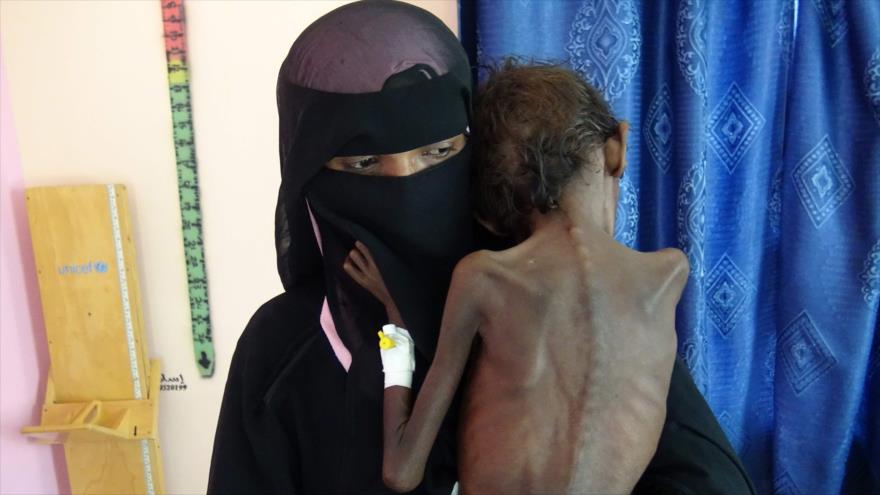 Una madre yemení sostiene en los brazos a su hijo de 5 años, que padece una desnutrición grave, en Al-Hudayda, 22 de noviembre de 2018. (Foto: AFP)