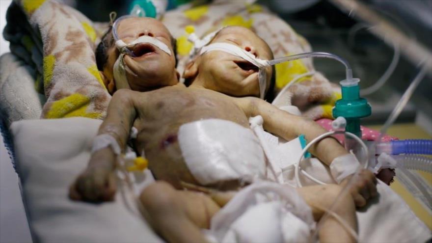 Gemelos unidos se encuentran en la unidad de cuidados intensivos para niños del hospital Al-Thawra en Saná, la capital yemení. (Foto: Reuters)