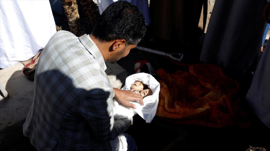 Fallecen bebés siameses por el bloqueo saudí contra Yemen