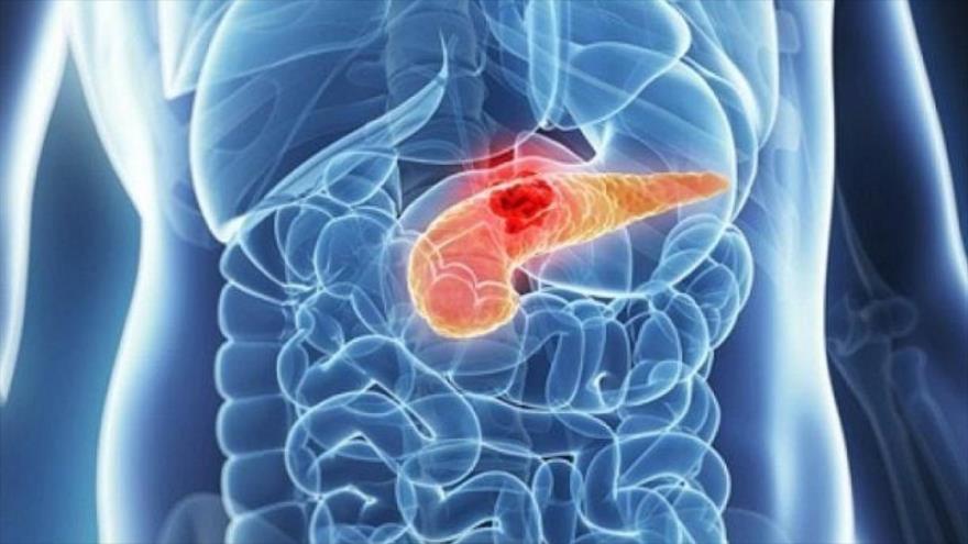 Ilustración de un páncreas con un tumor en el abdomen de una persona.