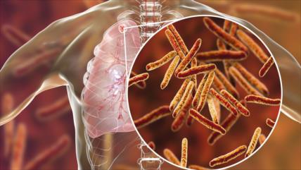 OMS: Combate a tuberculosis salva 54 millones de vidas 