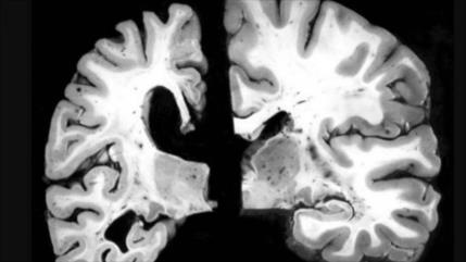 Estudio identifica alzhéimer 30 años antes de síntomas iniciales 