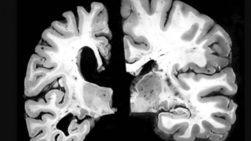 En la imagen de la izquierda un cerebro con alzhéimer. A la derecha, el cerebro sin la enfermedad.