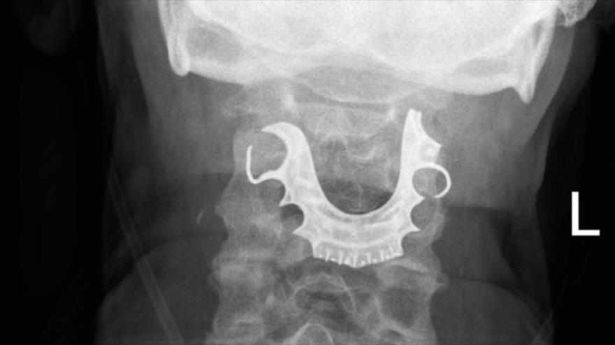 Radiografía de un anciano que sobrevivió más de una semana con una dentadura postiza atorada en su garganta.
