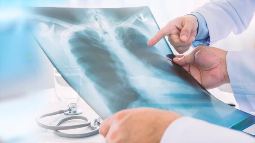 Un grupo de científicos halla una proteína en los tejidos pulmonares que puede ayudar a curar el cáncer de pulmón.