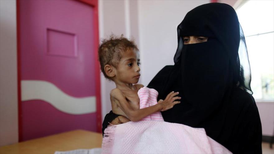 Niños yemeníes sufrirán hambre durante 20 años por guerra saudí	 | HISPANTV