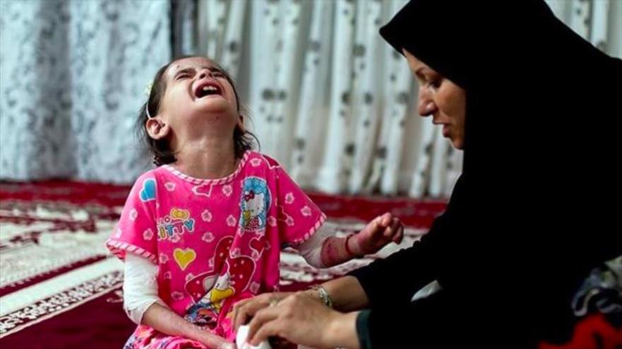 Una niña iraní que padece la epidermólisis ampollar (EB, por sus siglas en inglés).