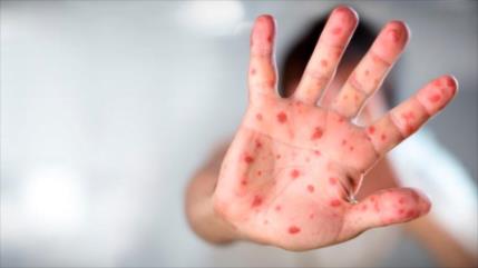 OMS alerta: Más de 142 000 personas murieron de sarampión en 2018