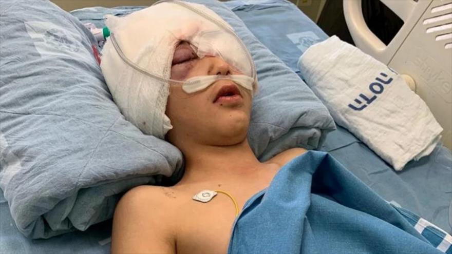 Vídeo: Niño palestino se queda ciego de un ojo por disparo israelí