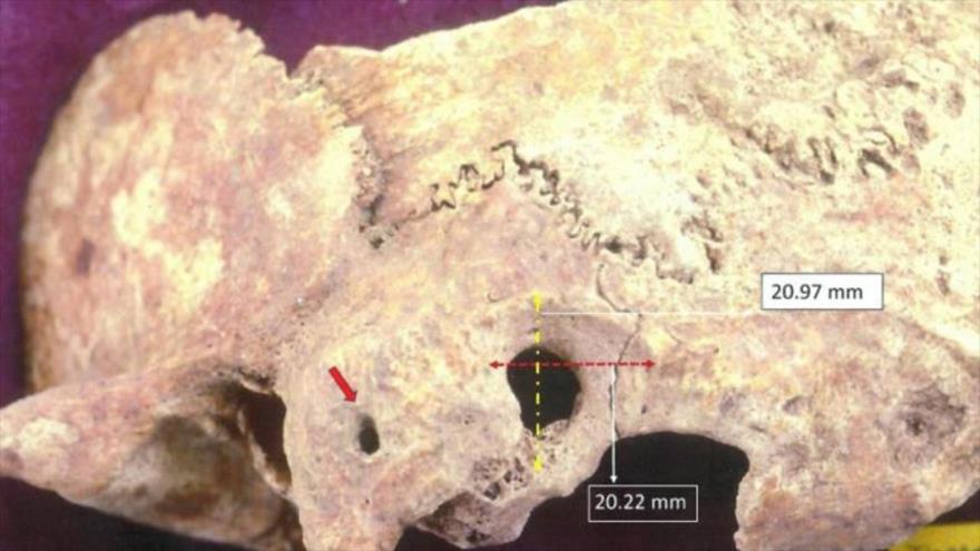 Vista del componente craneal que muestra intervención quirúrgica de hace 1500 años.