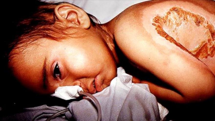 Un niño, víctima del ataque químico del régimen baasista iraquí a la ciudad de Sardasht (noroeste de Irán), junio de 1987.