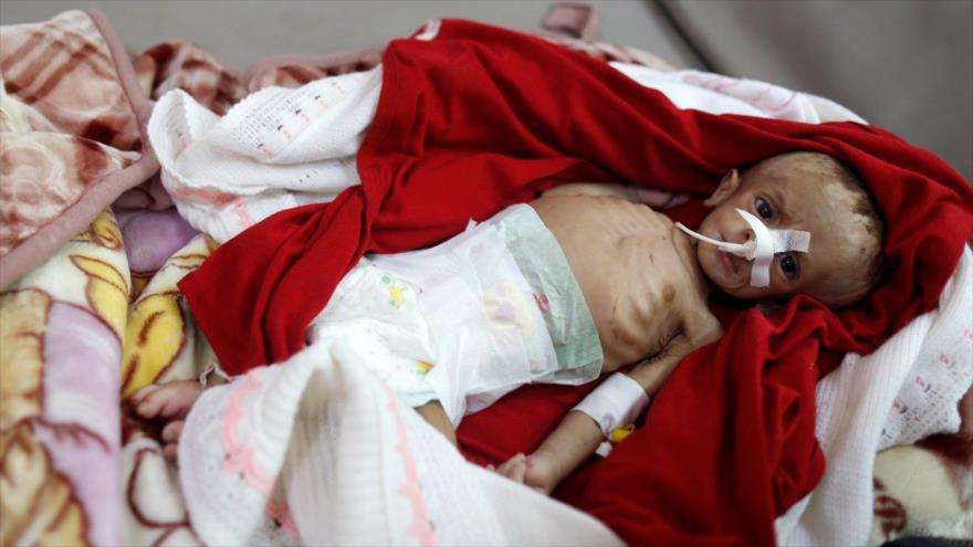 Un niño yace en una cama en la sala de desnutrición de un hospital en Saná, la capital de Yemen. (Foto: Reuters)