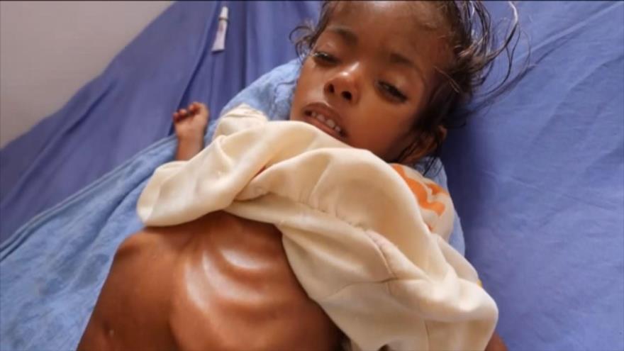Los niños yemeníes siguen muriendo por malnutrición | HISPANTV